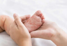 Adult holding babys foot with rash