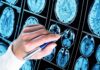 Study Shatters ‘Safe at 90’ Myth: Late-Life Dementia Spike Exposed Hand with pen pointing at brain MRI scans