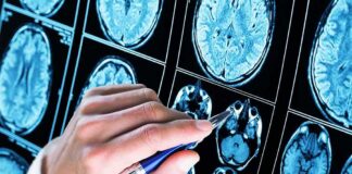 Hand with pen pointing at brain MRI scans